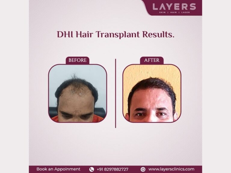 Layers, A Hair Transplant Clinic in Hyderabad, Implements Direct Hair Implantation (DHI) To Help Its Clients Tackle Premature Baldness